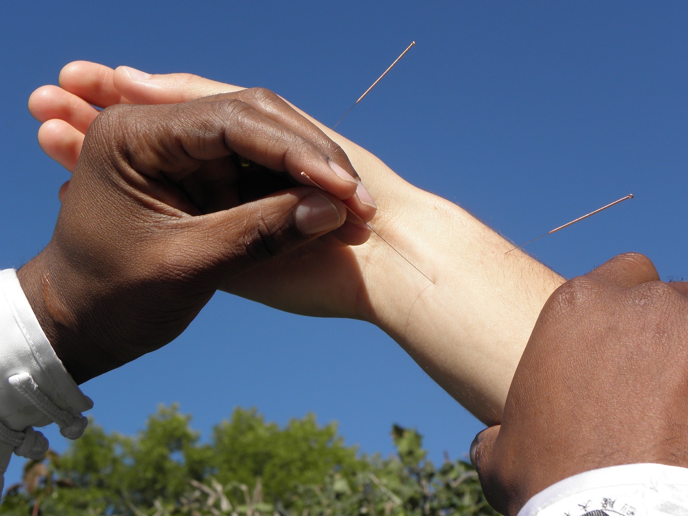 ACUPUNCTURE